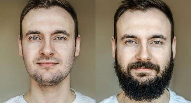Пересадка волос на бороду